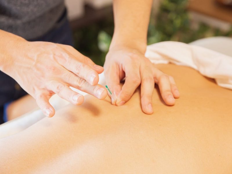 Afvallen door acupunctuur